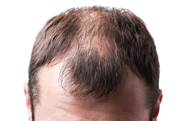 hair regrowth treatments