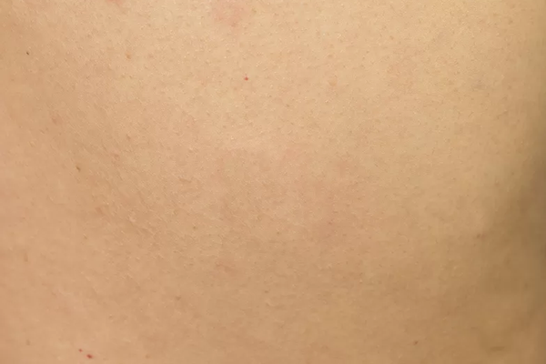 LaPiel_Cyst_After LaPiel_Cyst_After