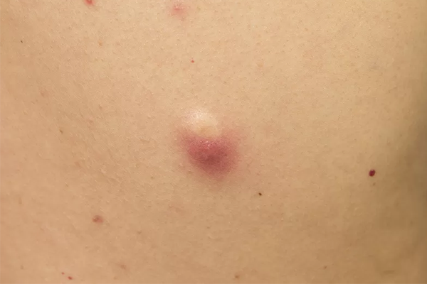 LaPiel_Cyst_Before LaPiel_Cyst_Before