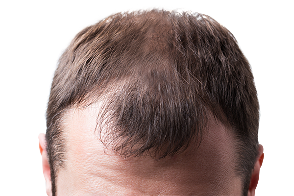 LaPiel_Hair_Transplantation_After