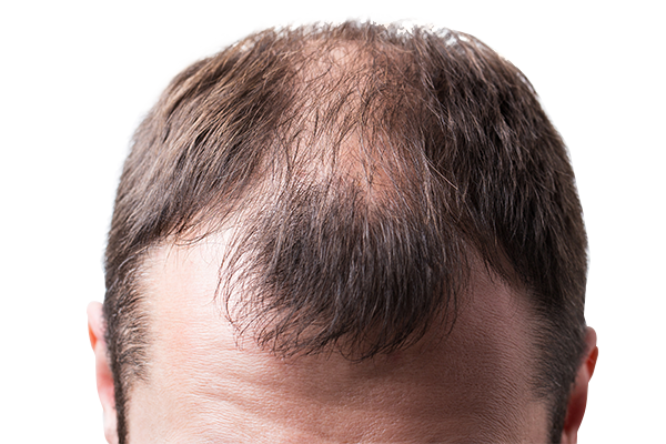 LaPiel_Hair_Transplantation_Before