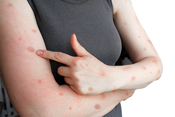 LaPiel_Skin_Infection_Before